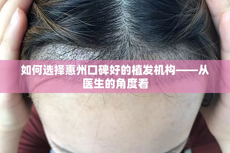 如何选择惠州口碑好的植发机构——从医生的角度看