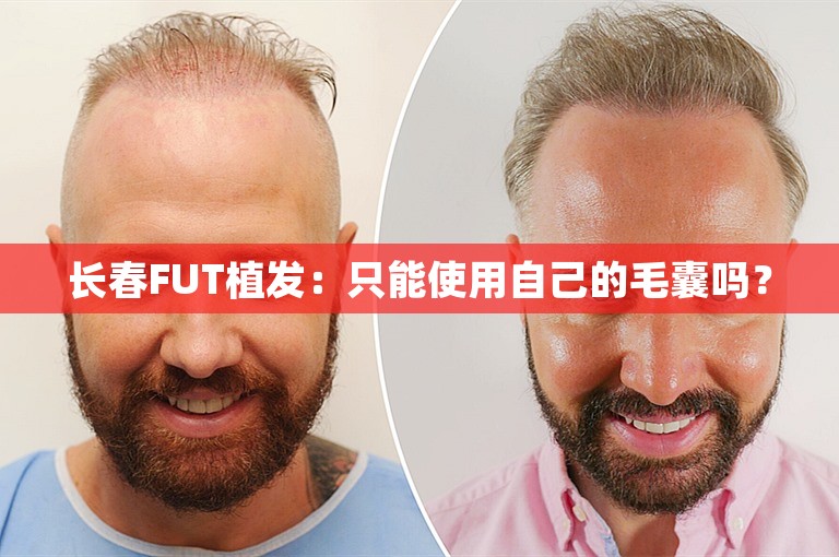 长春FUT植发：只能使用自己的毛囊吗？