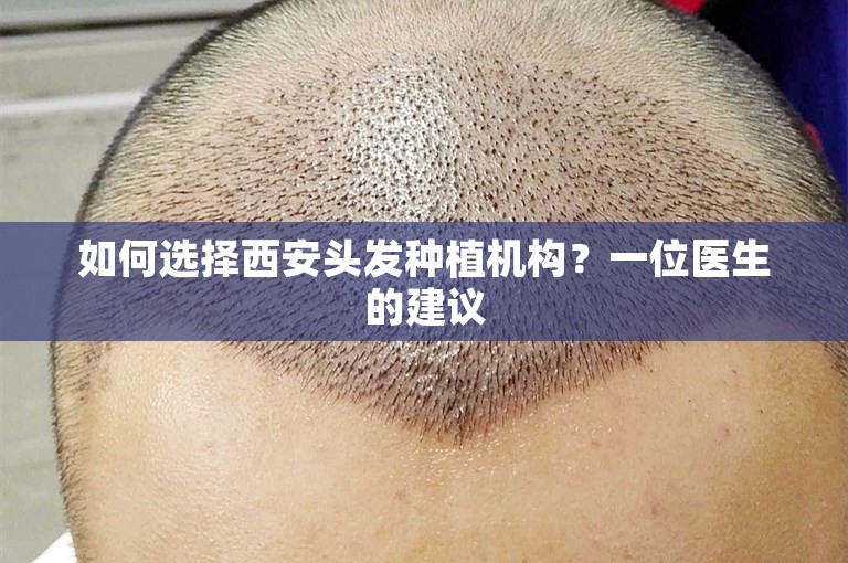 如何选择西安头发种植机构？一位医生的建议