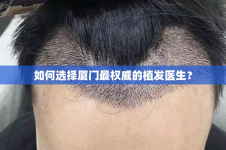 如何选择厦门最权威的植发医生？