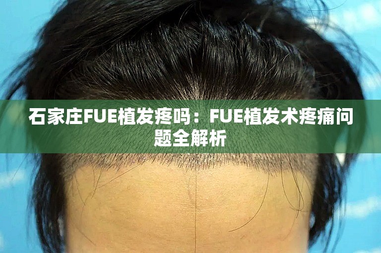 石家庄FUE植发疼吗：FUE植发术疼痛问题全解析