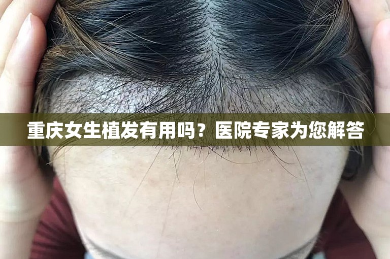 重庆女生植发有用吗？医院专家为您解答