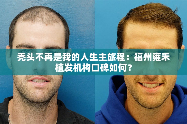 秃头不再是我的人生主旅程：福州雍禾植发机构口碑如何？