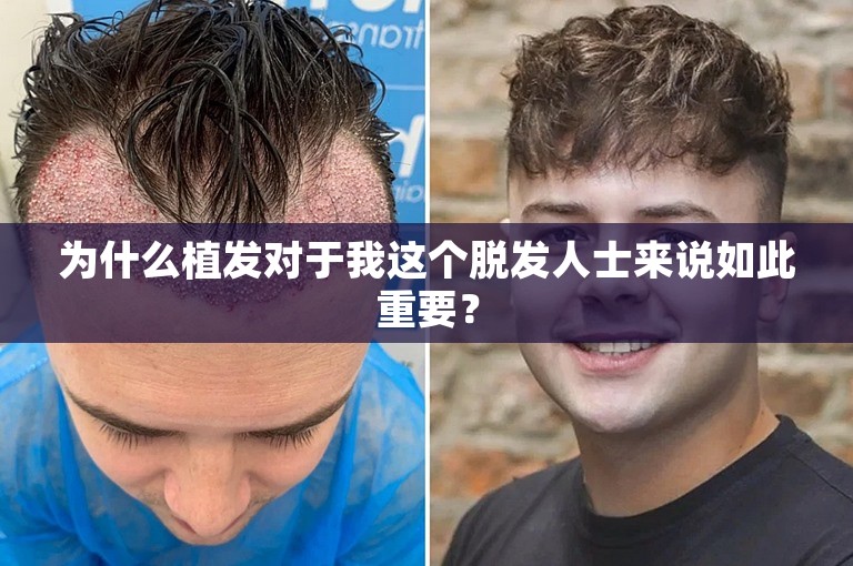 为什么植发对于我这个脱发人士来说如此重要？