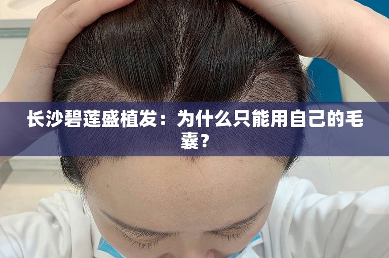 长沙碧莲盛植发：为什么只能用自己的毛囊？