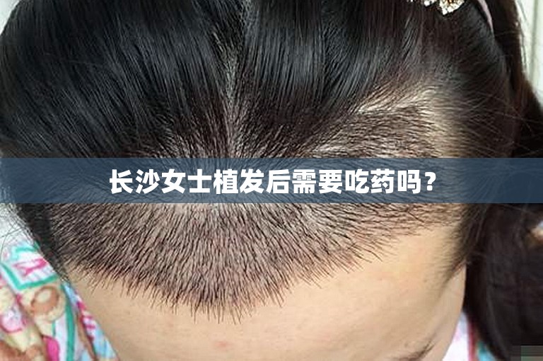 长沙女士植发后需要吃药吗？