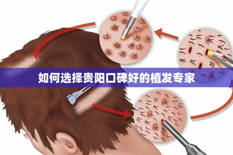 如何选择贵阳口碑好的植发专家