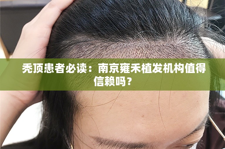  秃顶患者必读：南京雍禾植发机构值得信赖吗？