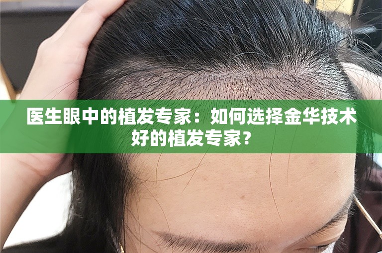 医生眼中的植发专家：如何选择金华技术好的植发专家？