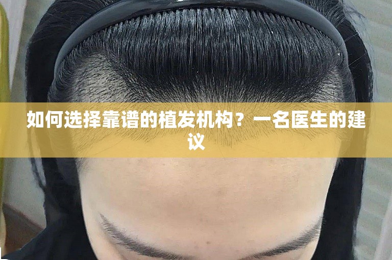 如何选择靠谱的植发机构？一名医生的建议