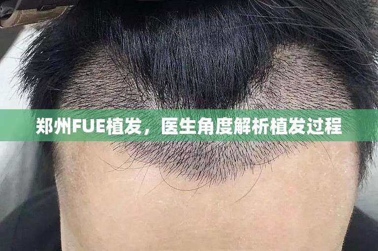 郑州FUE植发，医生角度解析植发过程