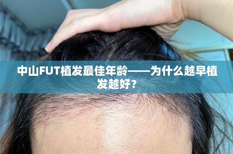 中山FUT植发最佳年龄——为什么越早植发越好？