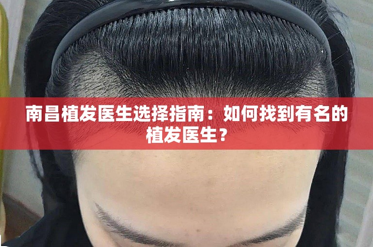 南昌植发医生选择指南：如何找到有名的植发医生？