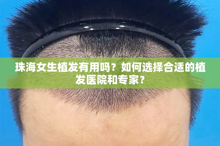 珠海女生植发有用吗？如何选择合适的植发医院和专家？