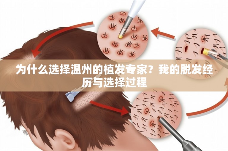 为什么选择温州的植发专家？我的脱发经历与选择过程