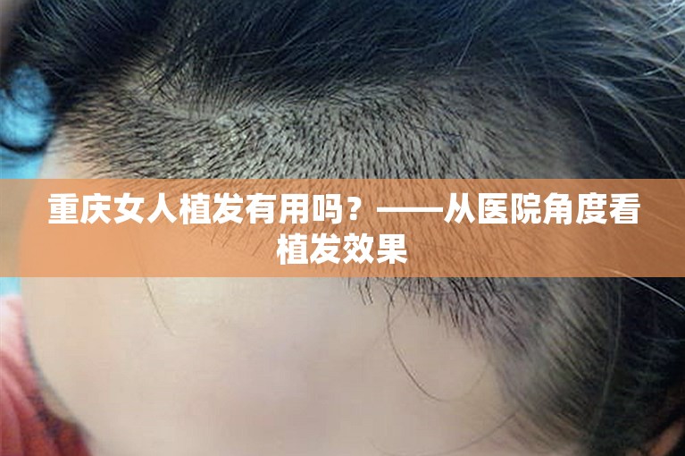 重庆女人植发有用吗？——从医院角度看植发效果