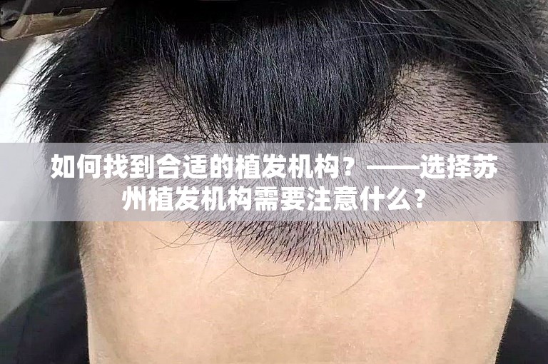 如何找到合适的植发机构？——选择苏州植发机构需要注意什么？