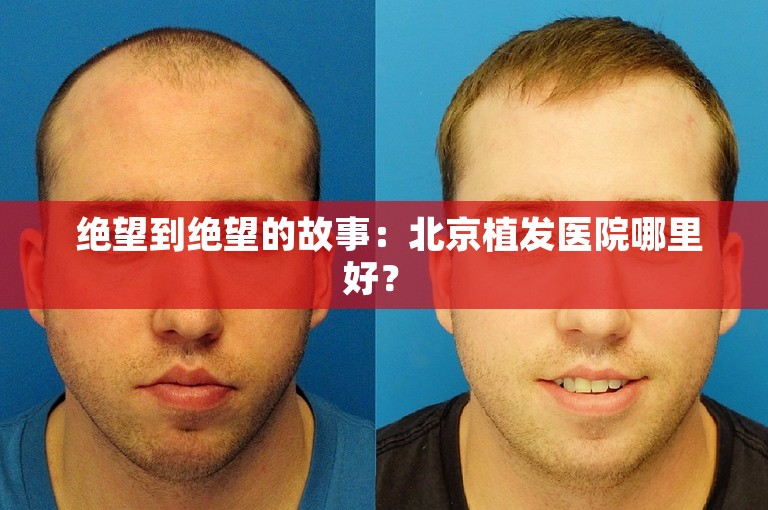  绝望到绝望的故事：北京植发医院哪里好？ 