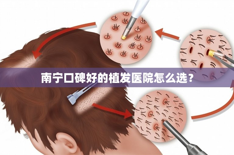 南宁口碑好的植发医院怎么选？