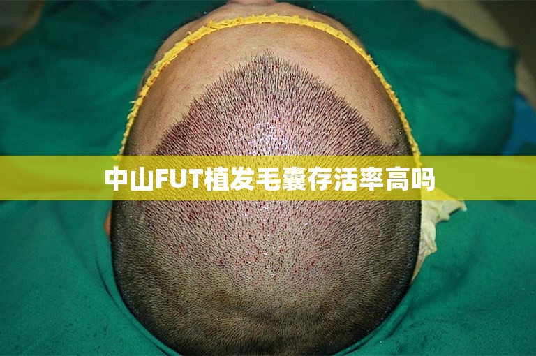 中山FUT植发毛囊存活率高吗