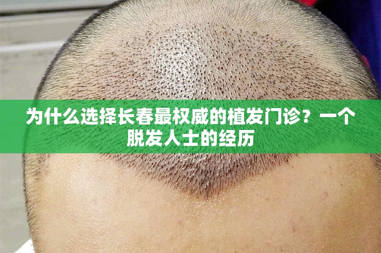 为什么选择长春最权威的植发门诊？一个脱发人士的经历