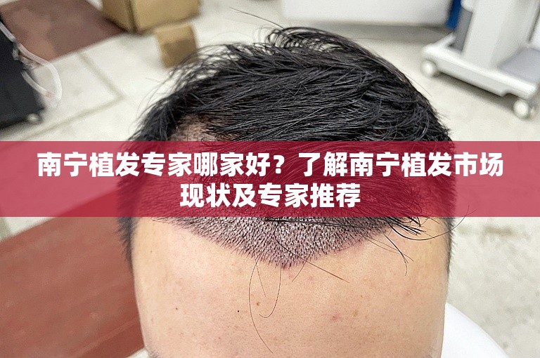 南宁植发专家哪家好？了解南宁植发市场现状及专家推荐