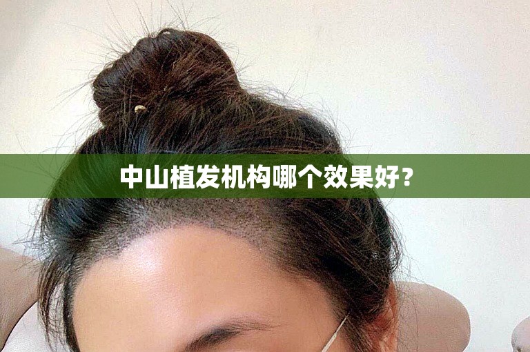 中山植发机构哪个效果好？