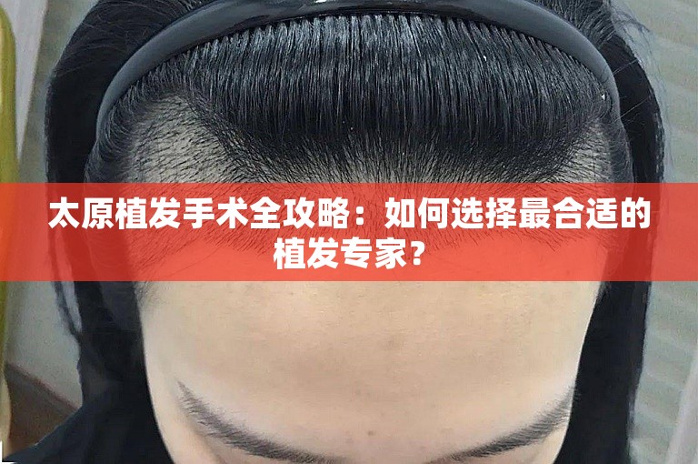 太原植发手术全攻略：如何选择最合适的植发专家？