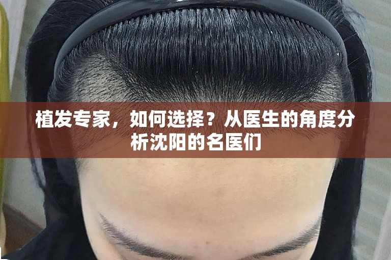 植发专家，如何选择？从医生的角度分析沈阳的名医们