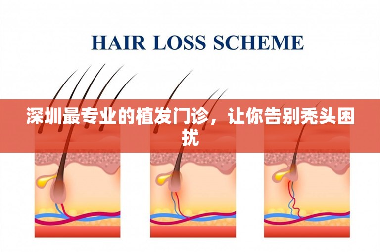深圳最专业的植发门诊，让你告别秃头困扰