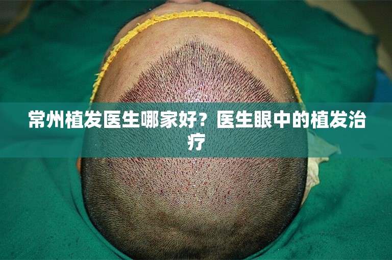 常州植发医生哪家好？医生眼中的植发治疗