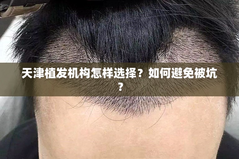 天津植发机构怎样选择？如何避免被坑？