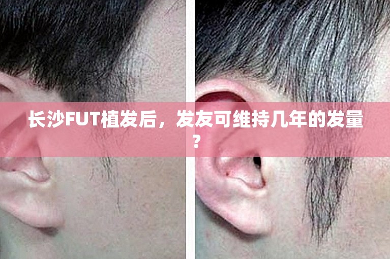 长沙FUT植发后，发友可维持几年的发量？