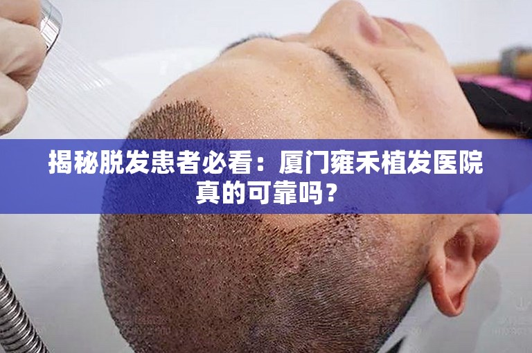 揭秘脱发患者必看：厦门雍禾植发医院真的可靠吗？