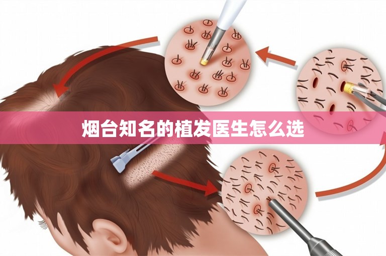  烟台知名的植发医生怎么选 