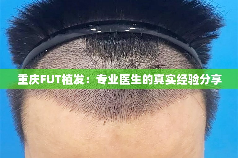 重庆FUT植发：专业医生的真实经验分享