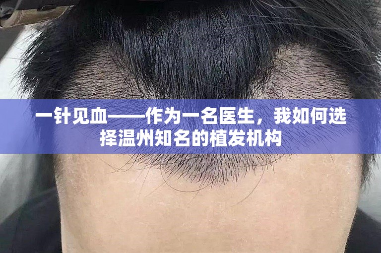 一针见血——作为一名医生，我如何选择温州知名的植发机构