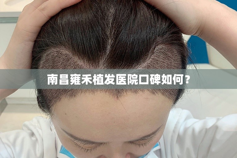 南昌雍禾植发医院口碑如何？