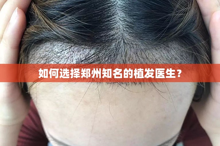 如何选择郑州知名的植发医生？