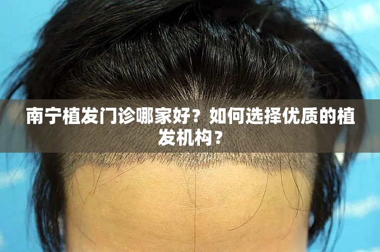 南宁植发门诊哪家好？如何选择优质的植发机构？