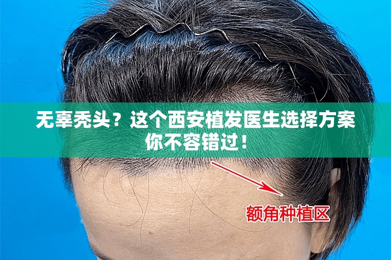 无辜秃头？这个西安植发医生选择方案你不容错过！