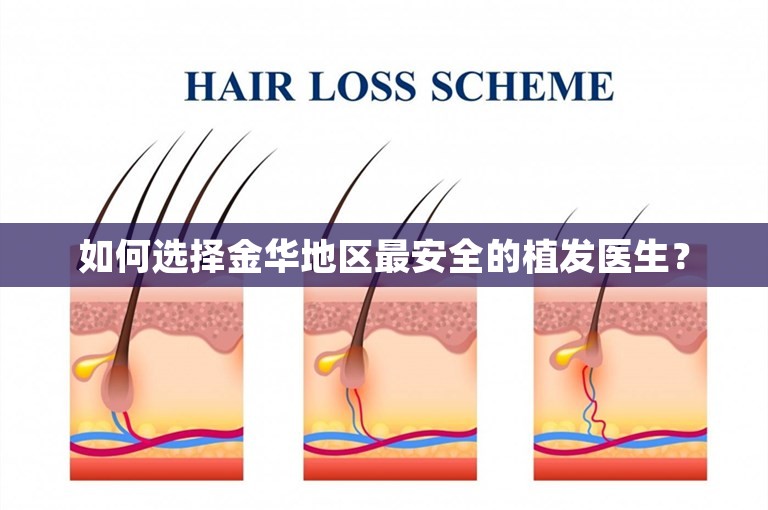 如何选择金华地区最安全的植发医生？