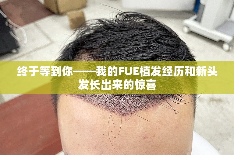 终于等到你——我的FUE植发经历和新头发长出来的惊喜