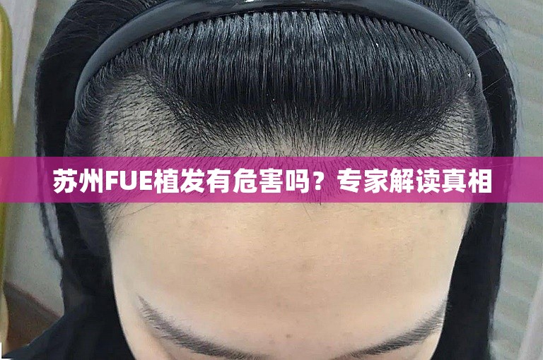 苏州FUE植发有危害吗？专家解读真相