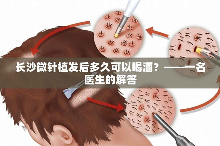 长沙微针植发后多久可以喝酒？——一名医生的解答