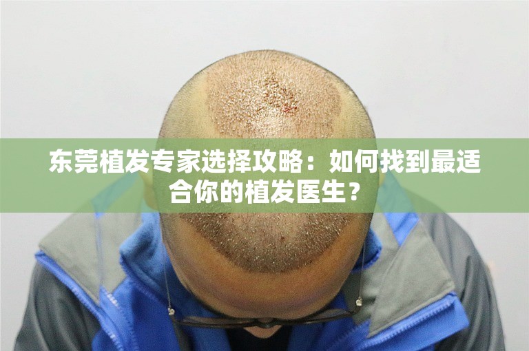 东莞植发专家选择攻略：如何找到最适合你的植发医生？