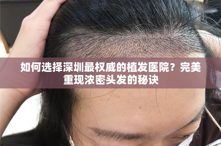 如何选择深圳最权威的植发医院？完美重现浓密头发的秘诀