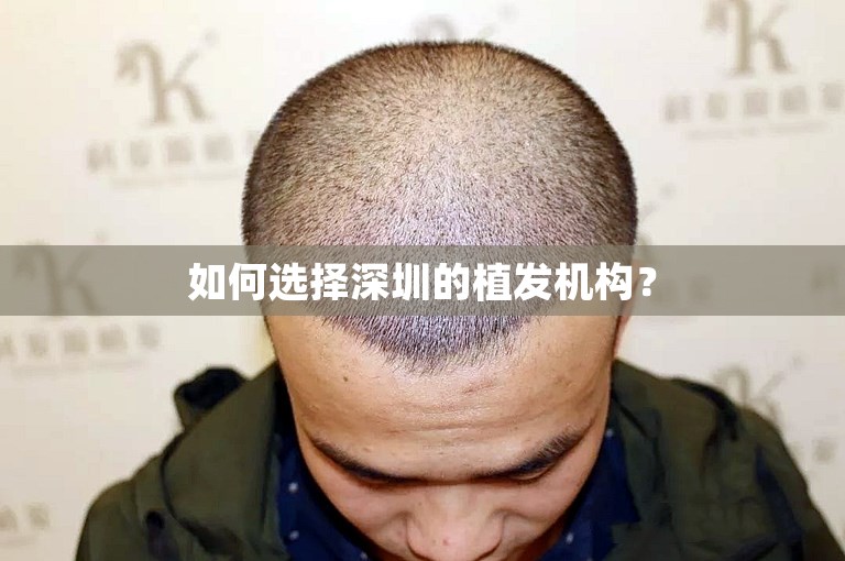 如何选择深圳的植发机构？