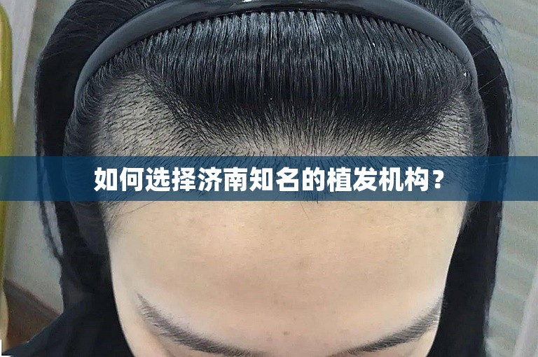 如何选择济南知名的植发机构？