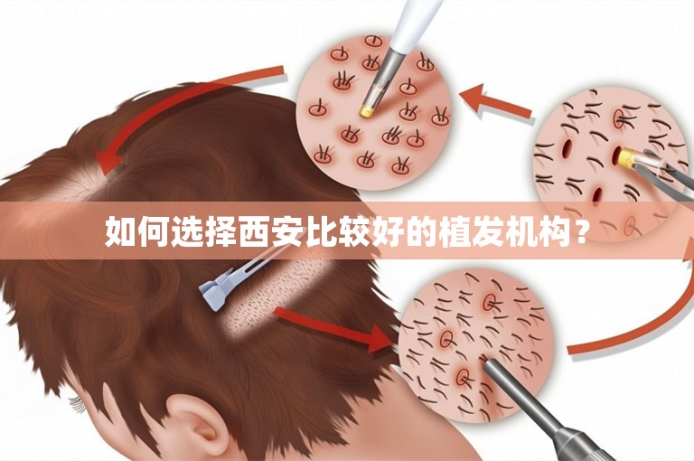 如何选择西安比较好的植发机构？